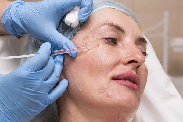 Cosmetic treatment with botox injection — Stock Photo, Image