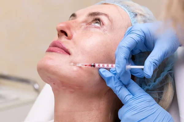 Kosmetisk behandling med botox injektion — Stockfoto