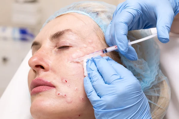 Kosmetisk behandling med botox injektion — Stockfoto