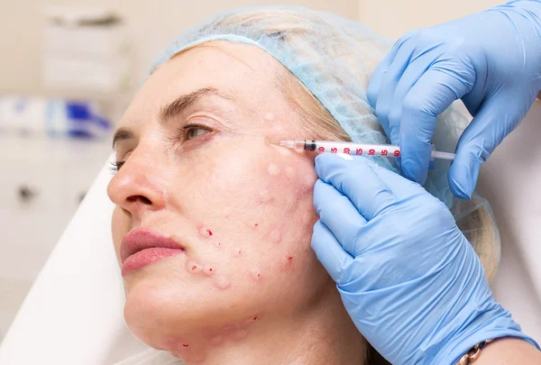 Trattamento cosmetico con iniezione di botox — Foto Stock