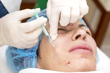 Enjeksiyon ile kozmetik tedavi