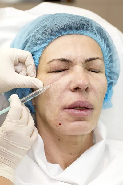 Cosmetic treatment with injection — Stock Photo, Image