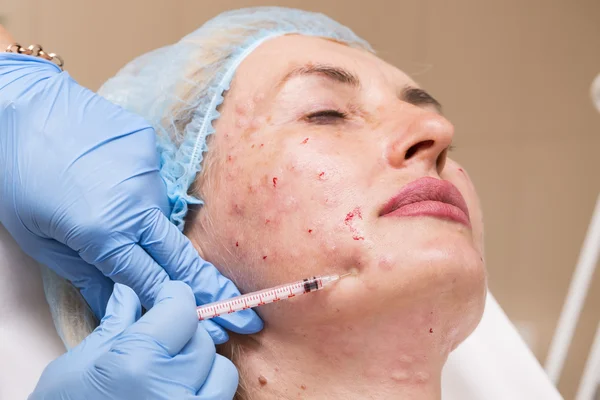 Cosmetic treatment with injection — Stock Photo, Image