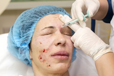 Enjeksiyon ile kozmetik tedavi