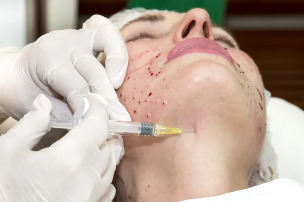 Cosmetic treatment with injection — Stock Photo, Image