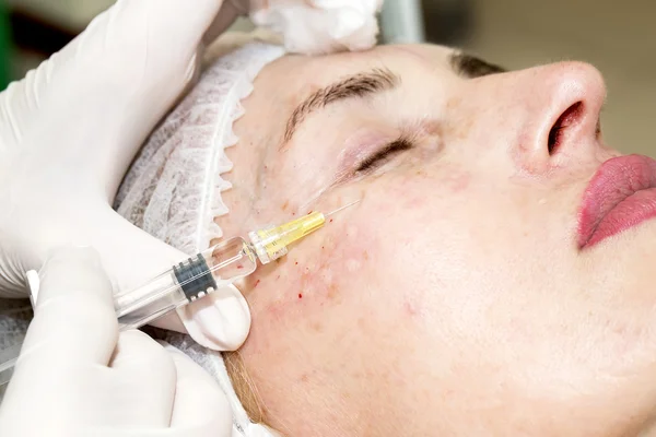 Cosmetic treatment with injection — Stock Photo, Image