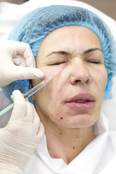 Cosmetic treatment with injection — Stock Photo, Image