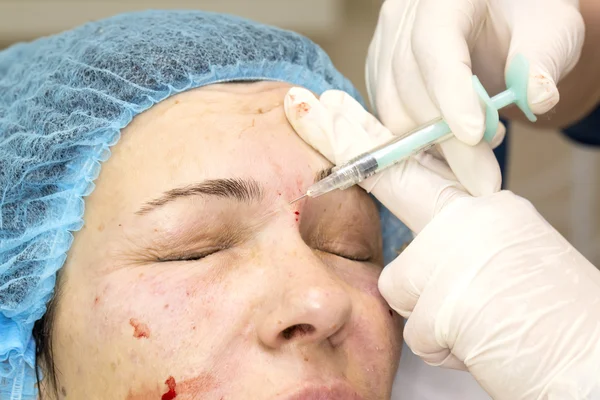 Cosmetic treatment with injection — Stock Photo, Image