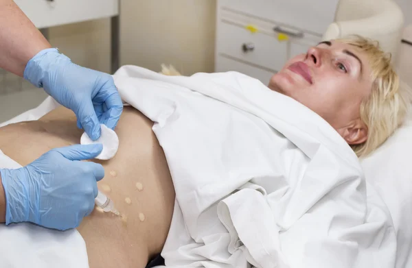 Женщина во время целлюлитной мезотерапии — стоковое фото