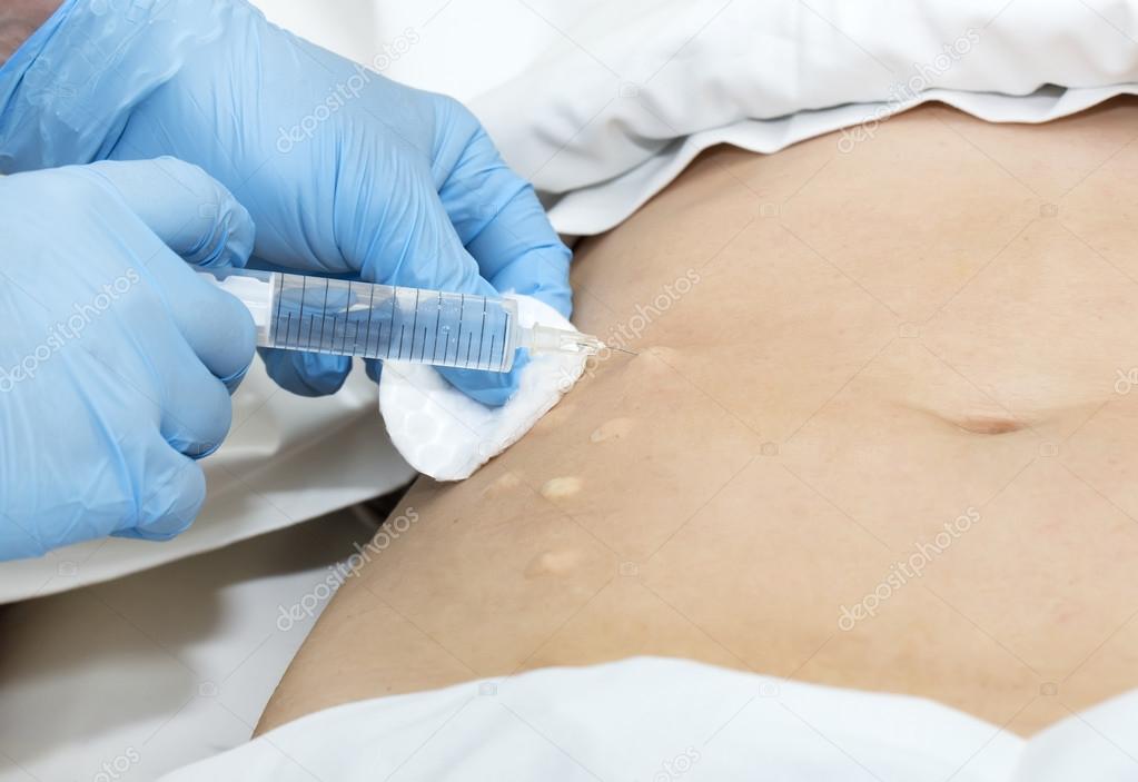 woman during cellulite mesotherapy