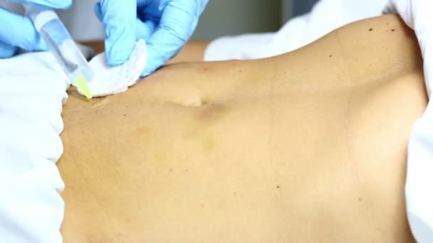 Жінка під час мезотерапії целюліту — стокове відео