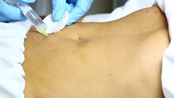 Femme pendant la mésothérapie cellulite — Video