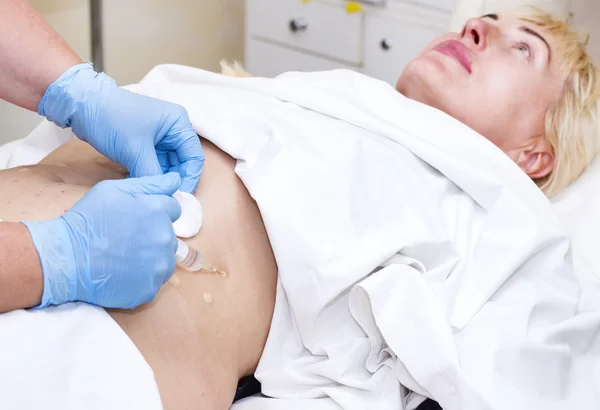 Mujer está en el proceso de celulitis — Foto de Stock