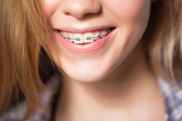 Porträtt av teen flicka visar dental hängslen. Stockbild