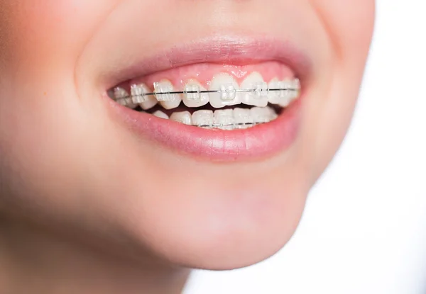 Mulher com aparelho dentário — Fotografia de Stock