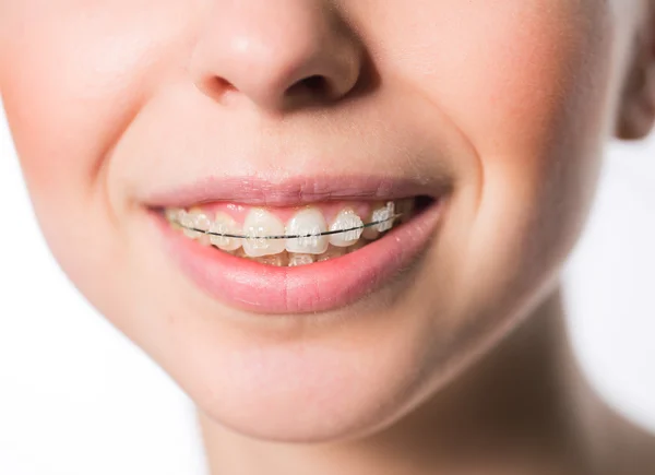 Boca de mujer con aparatos dentales — Foto de Stock