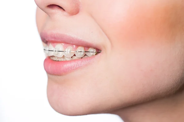 Ženská ústa s zuby rovnátka — Stock fotografie