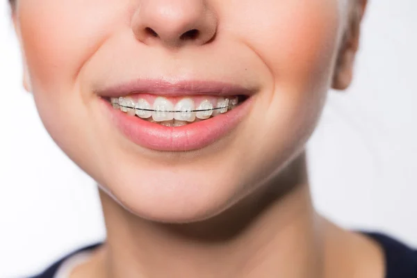 Boca de mujer con aparatos dentales — Foto de Stock