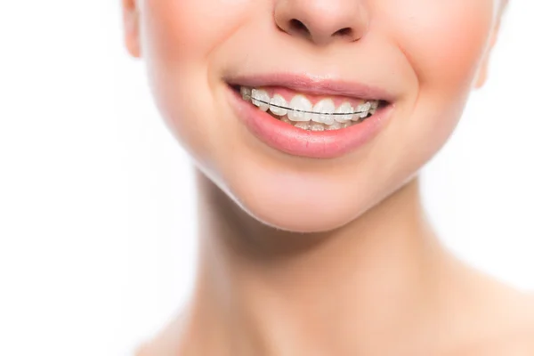 Ženská ústa s zuby rovnátka — Stock fotografie