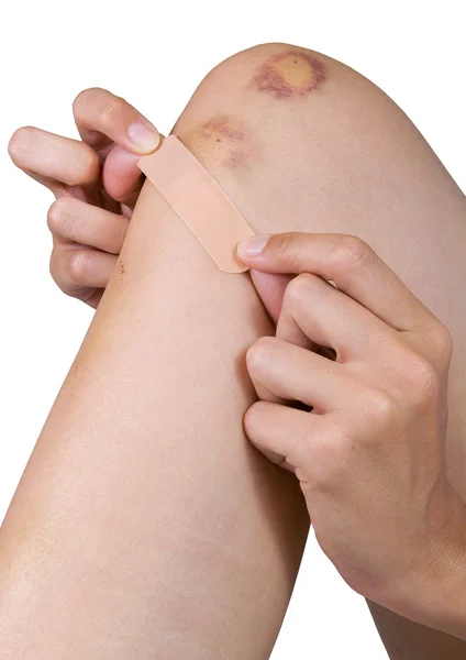 Plaster leg — Stock Photo, Image