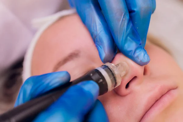 Frau reinigt Nasenporen mit Vakuum-Mitesser-Entferner, kosmetisches Verfahren. — Stockfoto