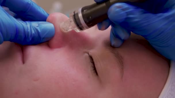 Жінка очищає пори шкіри носа, використовуючи вакуумне видалення чорної голови, косметична процедура . — стокове відео