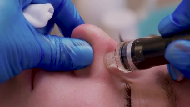 Жінка очищає пори шкіри носа, використовуючи вакуумне видалення чорної голови, косметична процедура . — стокове відео