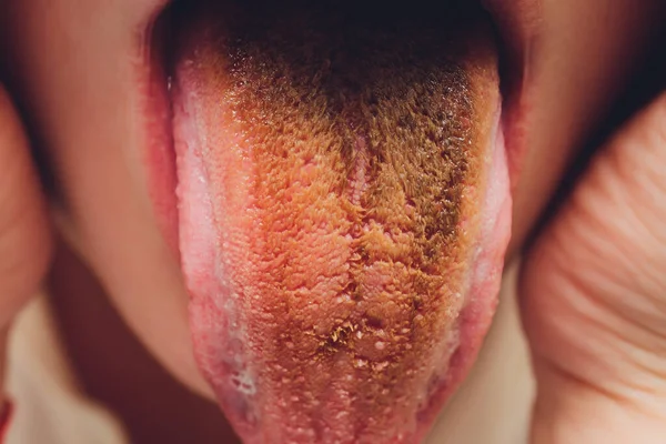 Língua suja, close-up, marrom escuro após refrigerante. — Fotografia de Stock