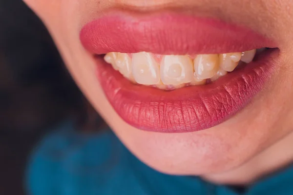 Sistema de abrazaderas en una boca sonriente de chicas, macrofotografía de dientes. cara grande y labios pintados. Tirantes en los dientes de una chica que sonríe. —  Fotos de Stock