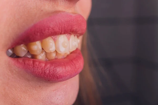 Sistema de abrazaderas en una boca sonriente de chicas, macrofotografía de dientes. cara grande y labios pintados. Tirantes en los dientes de una chica que sonríe. —  Fotos de Stock