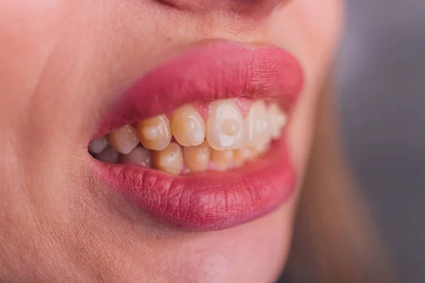 Brasket system i en flicka leende mun, makrofotografier av tänder. stort ansikte och målade läppar. Hängslen på tänderna på en flicka som ler. — Stockfoto