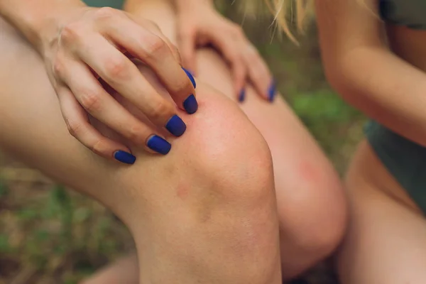Primer plano de rascarse la mano en el cuerpo con picor en las piernas de la mujer joven. —  Fotos de Stock