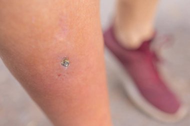 Pimple Folliculitis on buttock caused by infection from bacteria, yeast, fungus, irritation of hair follicles, or blockage of hair follicles.