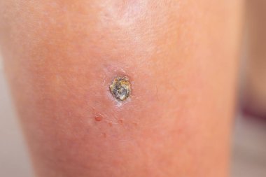 Pimple Folliculitis on buttock caused by infection from bacteria, yeast, fungus, irritation of hair follicles, or blockage of hair follicles.