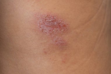 Kadınların dizinde sıyrık var. Kırmızı bir yarayla yaralı bir bacak. İlk yardım için tıbbi tedavi.