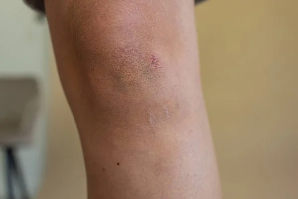 Abrasion on the womans knee. Injured leg with a red wound. Medical treatment for first aid. — Stock Photo, Image