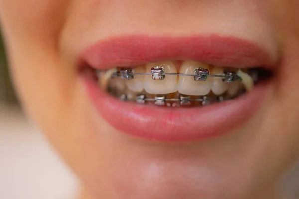 Beautiful young woman with brackets on teeth close up. — Stock Photo, Image