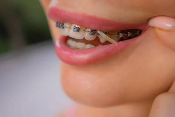 Vacker ung kvinna med parentes på tänderna närbild. — Stockfoto