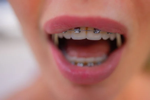 Hermosa joven con corchetes en los dientes de cerca. — Foto de Stock