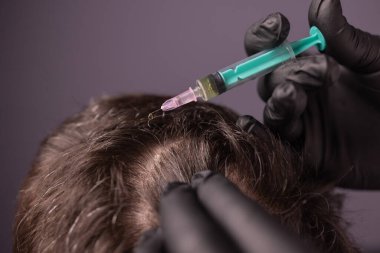 Saç için mezoterapi. Çekici bir adam kafasından iğne vuruluyor. Güzellik salonunda mezoterapi gören bir adam, şırıngalı koruyucu eldivenli bir terapist.,
