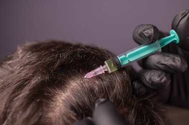 Saç için mezoterapi. Çekici bir adam kafasından iğne vuruluyor. Güzellik salonunda mezoterapi gören bir adam, şırıngalı koruyucu eldivenli bir terapist.,