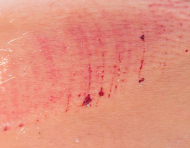 Bacak derisindeki kazadan kaynaklanan lezyon..