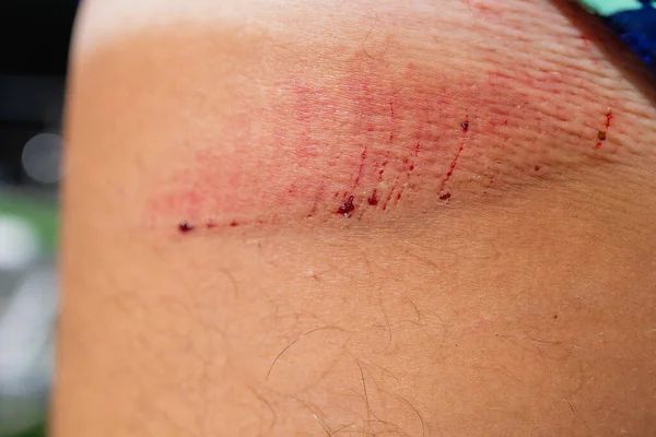 Scratch lesion caused by the accident on leg skin. — Stock Photo, Image