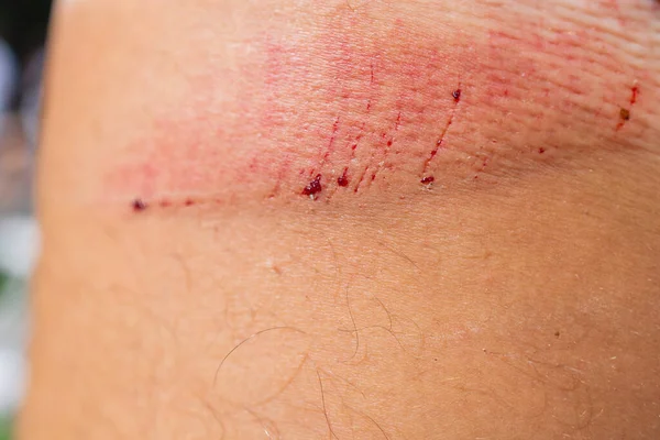 Scratch lesion caused by the accident on leg skin. — Stock Photo, Image