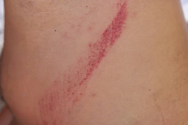 Lesão de arranhão causada pelo acidente na pele da perna. — Fotografia de Stock