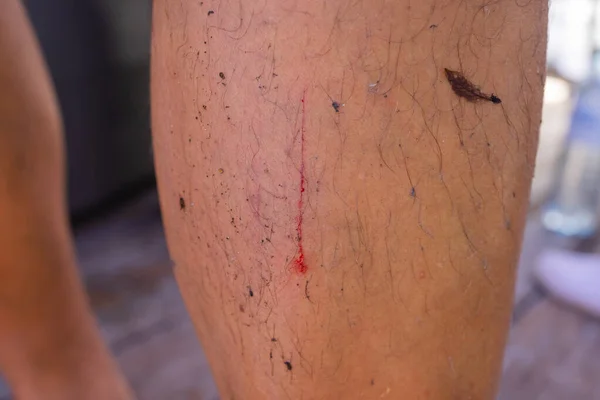 Scratch lesion caused by the accident on leg skin. — Stock Photo, Image