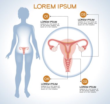 Yumurtalık. Modern tıbbi infographics. 