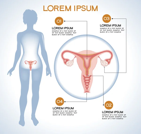 Vaječníky. Moderní lékařské infografika. — Stockový vektor