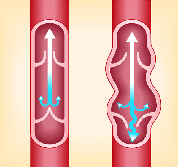 красные вены варикозного расширения

