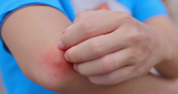 Homem coçar coceira mosquito colisão — Vídeo de Stock